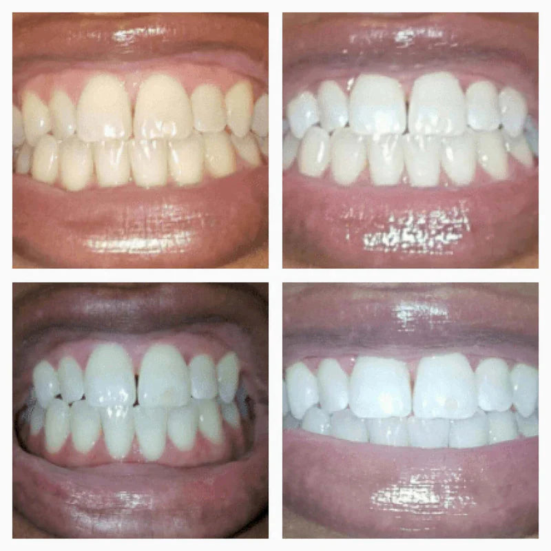 Smileé™ – Stylo Blanchissant Dentaire